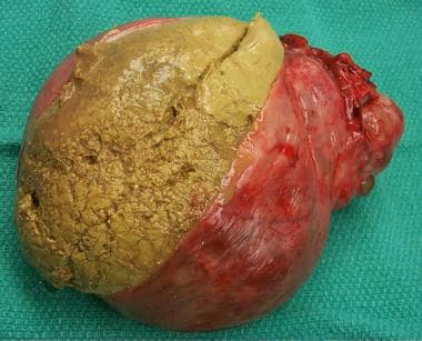 How is ruptured chocolate cyst dangerous?