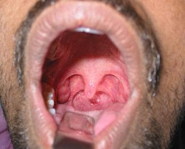 Palatine tonsils. 