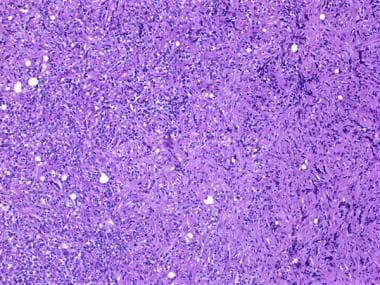 The histology of lymphoma is composed of atypical 