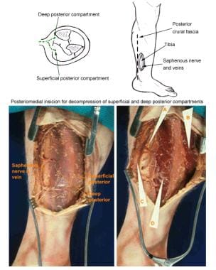 (Click Image to enlarge.) Two-incision posteromedi