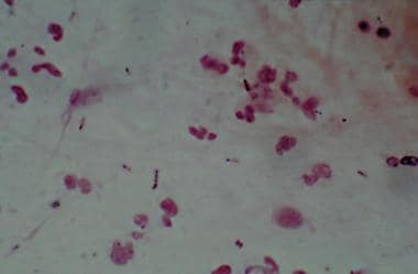 Gram stain showing Streptococcus pneumoniae. 