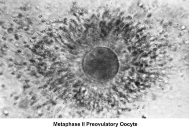 Infertility. Metaphase II preovulatory oocyte. Ima