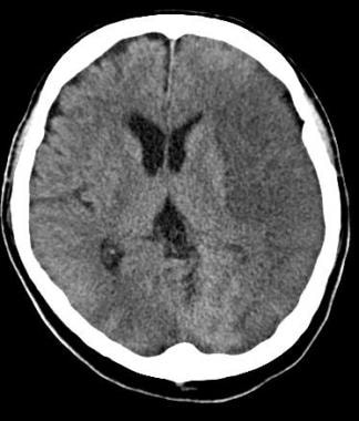 Follow-up noncontrast CT scan obtained approximate