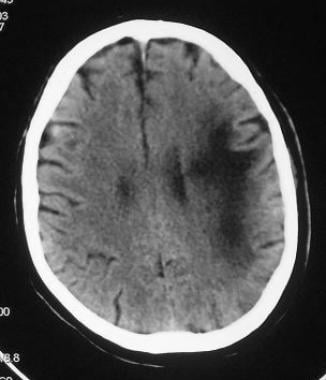 Nonenhanced CT of the head shows a hypoattenuating
