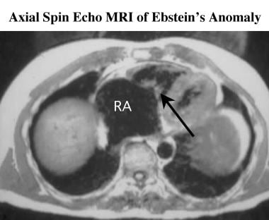Axial ECG-gated spin-echo MRI in a patient with Eb