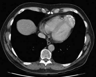 Ventricular Aneurysm Imaging: Practice Essentials, Radiography, Computed Tomography