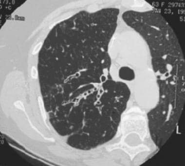 This HRCT scan through the right upper lobe demons