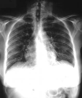 reticulum cell sarcoma x ray