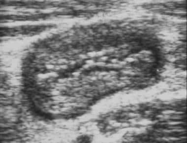 Crohn disease. Sonogram of a thickened bowel wall 