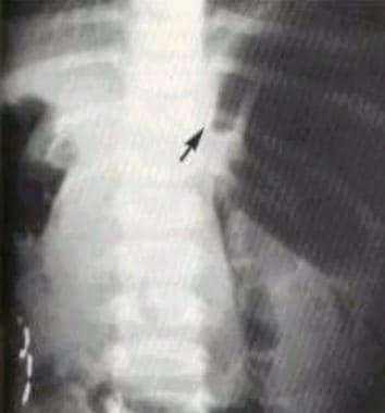 Supine abdominal image shows a mesenteroaxial volv