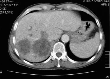 Contrast-enhanced CT scan in a patient with colore