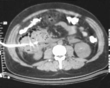 Acute pancreatitis. Pancreatic abscess. Large, rel