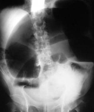 Erect abdominal radiograph. This image shows fluid