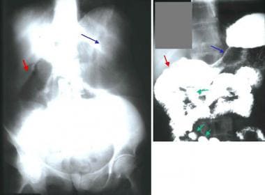 Plain abdominal radiograph shows a gas-filled, dil