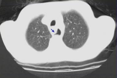 Nonenhanced CT scan through the mid esophagus in a