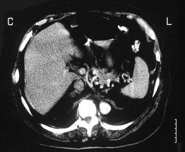 Axial enhanced CT scan through the adrenal glands 