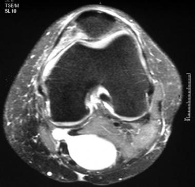 Axial, T2-weighted magnetic resonance image with f