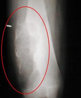 Anteroposterior radiograph of the distal femur of 
