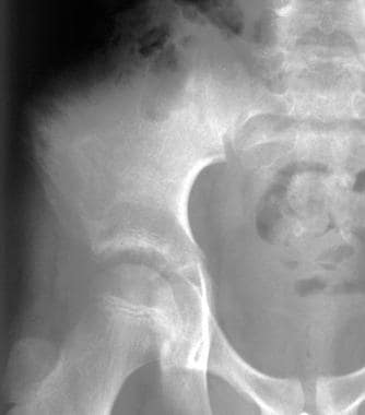 ewing sarcoma x ray