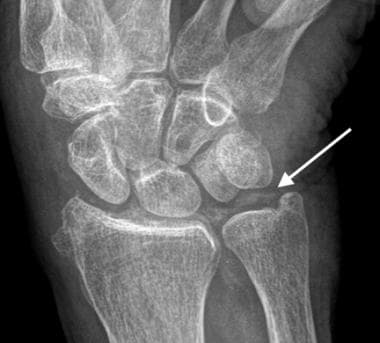 Oblique radiograph of the wrist in a patient with 