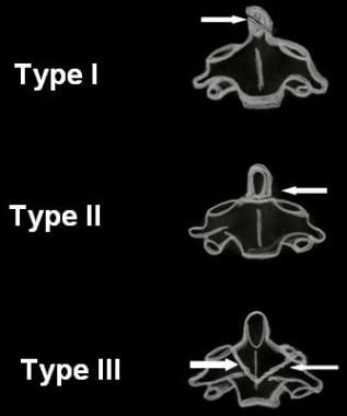 Upper Cervical Spine Trauma Imaging: Practice Essentials, Radiography ...