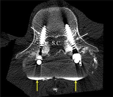 Lumbar spine trauma. Axial CT image after a lumbar