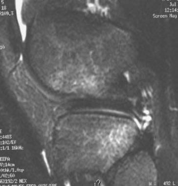 Pivot shift bone bruises of the femur and tibia as