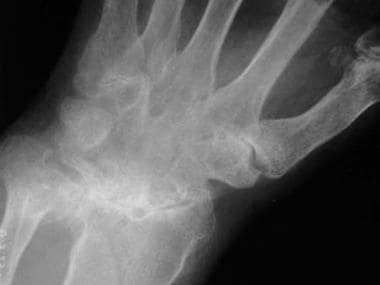 Marked ankylosis of most of the carpal bones in a 