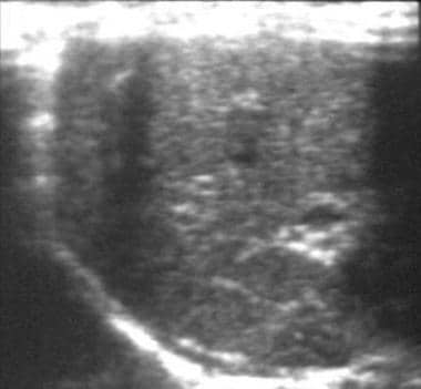 Polysplenia. Ultrasonogram of the left upper quadr