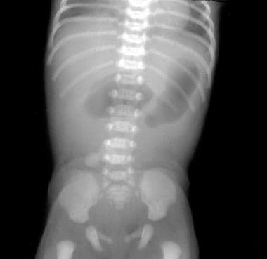 Anteroposterior radiograph of the abdomen depicts 