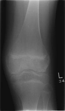 Plain radiograph of the knee shows osteopenia with