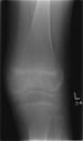 Juvenile Idiopathic (Rheumatoid) Arthritis Imaging and Diagnosis