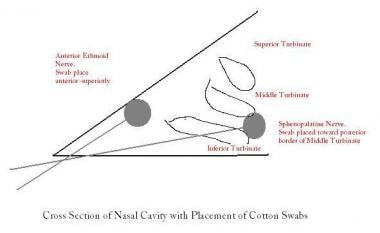 Placement of cotton swabs in the nasal cavity. 