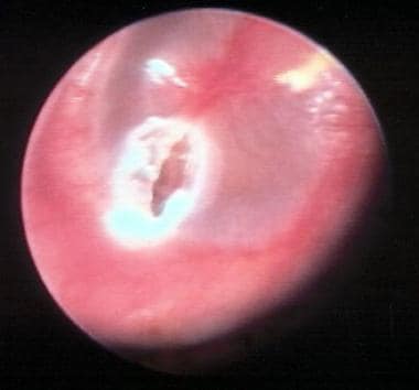 The picture shows a phenolized tympanic membrane w