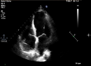 Transthoracic echocardiograph showing an apical fo