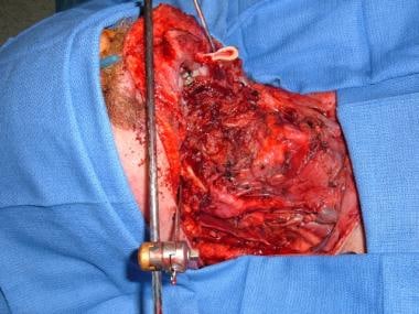 External fixator in place after mandibulectomy. Th