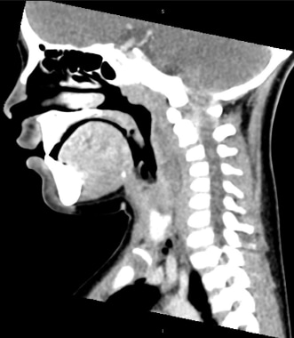 Lateral view X-ray showing the soft neck tissue and revealing