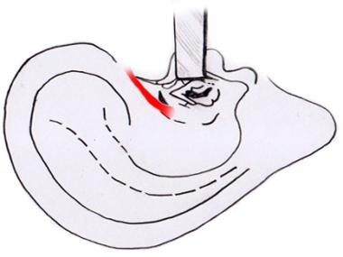Endaural incision to widen membranous external aud