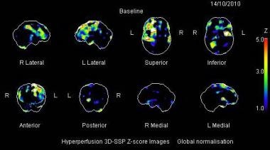 spect brain scan