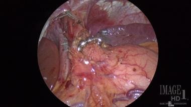 Hiatal Hernia. This image shows a Linx device in p
