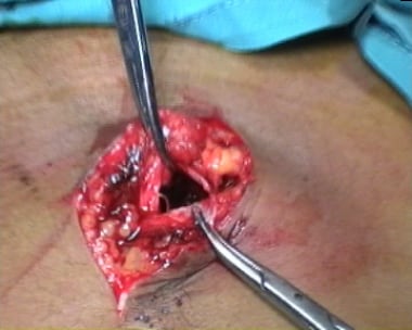 wound stab penetrating exploration abdominal technique midline