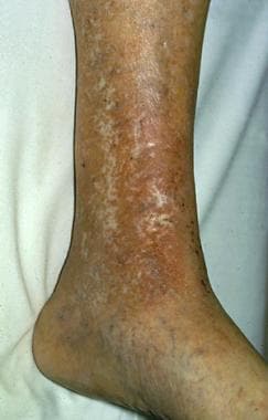 Eczema of legs on Black skin with erythema and lichenification