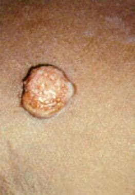 Initial papilloma, also called mother yaw or prima