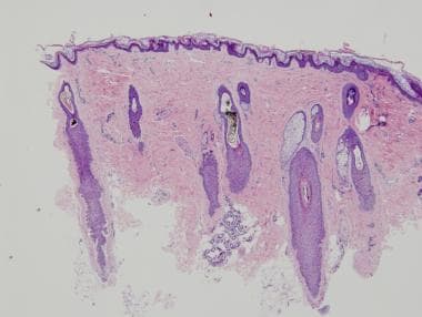 Histopathologically, trichomalacia (twisted pigmen