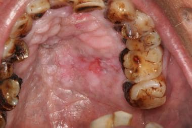 A reverse smoker with white and pigmented palatal 