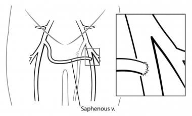 Chronic Venous Insufficiency - Elite Vein Clinic