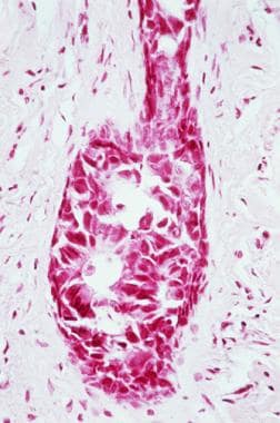 乳腺导管内癌的显微照片