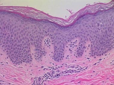 Histology of confluent and reticulated papillomatosis