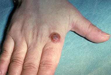 Orf Clinical Presentation History Physical Examination Complications