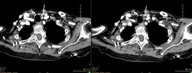 A small, left inferior parathyroid adenoma as demo